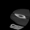 SPORK, NICO - 22.03.1976 - 02.08.2022 - CT obere Extremität - 17:51:17